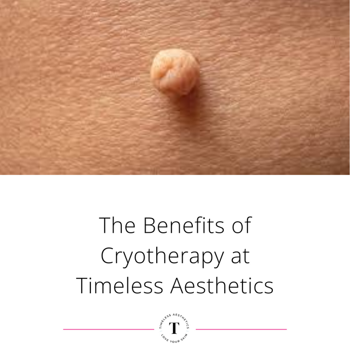 The Benefits of Cryotherapy at Timeless Aesthetics